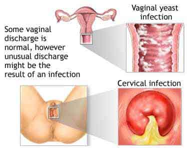 Vaginal Discharge